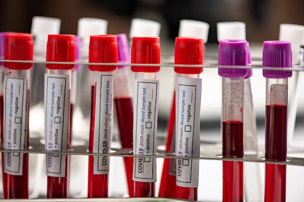 Blood test vials in laboratory setting